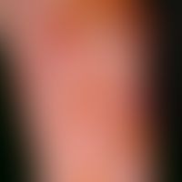 Differenzialdiagnose: Porphyria cutanea tarda&nbsp;

Diagnose: Bullöses Pemphigoid. Subepithelial...