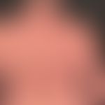 Differenzialdiagnose: Sklerodermie zirkumskripte (Plaque- oder Morphea-Typ)

Diagnose: Morphea-ar...