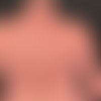 Differenzialdiagnose: Sklerodermie zirkumskripte (Plaque- oder Morphea-Typ)

Diagnose: Morphea-ar...