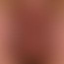 Differenzialdiganose:&nbsp;Skrotaldermatitis, pellagroide

Diagnose: Pemphigus familiaris Hailey-...