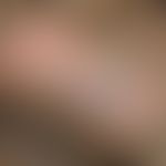 Skrotaldermatitis: Lichenifikation und flächige Erosionen als Folge ständigen Kratzens&nbsp;(Abbi...