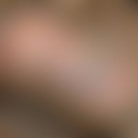 Skrotaldermatitis: Lichenifikation und flächige Erosionen als Folge ständigen Kratzens&nbsp;(Abbi...