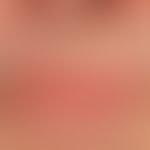 Differenzialdiagnose: Cheilitis simplex

Diagnose: Psoriasis vulgaris mit randlicher Einbeziehung...