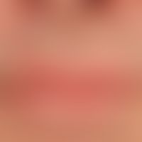 Differenzialdiagnose: Cheilitis simplex

Diagnose: Psoriasis vulgaris mit randlicher Einbeziehung...