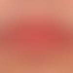 Cheilitis simplex&nbsp;(sicca) nach Isotretinoin-Therapie wegen Acne vulgaris.
