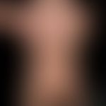 Differenzialdiagnose:&nbsp;Naevus flammeus asymmetrischer&nbsp;

Diagnose: Cutis marmorata telean...