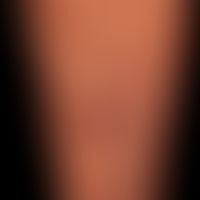 Differenzialdiagnose: Prurigo nodularis

Diagnose: Papulöse Dermatitis in der Schwangerschaft&nbs...