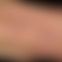 Dermatitis herpetiformis:&nbsp;chronisch rezidivierender&nbsp;Krankheitsverlauf.&nbsp;Disseminier...