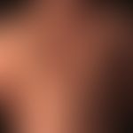 Differenziadiagnose "Tinea corporis"

Diagnose:&nbsp;- hier vorliegend eine seborrhoische Dermati...