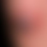 Dermatofibrosarcoma protuberans:&nbsp;solitärer, chronisch dynamischer, seit 4-5 Jahren kontinuie...