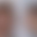 Nijmegen-Breakage-Syndrom:Typische Physiognomie. Abb. entnommen aus:&nbsp;Chrzanowska KH et al. (...