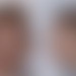 Nijmegen-Breakage-Syndrom:Typische Physiognomie. Abb. entnommen aus:&nbsp;Chrzanowska KH et al. (...