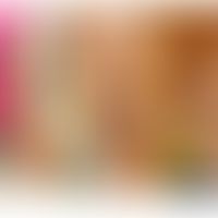 Prurigo chronische vom Typ Prurigo nodularis. Abb. entommen aus:&nbsp;Kwon CD et al. (2019)
