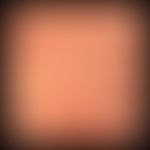 Prurigo nodularis:&nbsp;angedeutete Linearität&nbsp;der Papeln und Knoten. Beachte die komplett u...