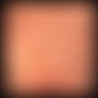 Prurigo nodularis:&nbsp;angedeutete Linearität&nbsp;der Papeln und Knoten. Beachte die komplett u...