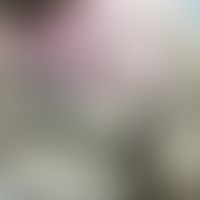 Eosinophile Dermatose bei hämatologischer Neoplasie:&nbsp; zosteriform angeordnete wenig juckende...
