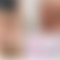 Haarzellleukämie: Spezifische Infiltrate der Haut. Abbildungen entnommen aus: Robak E et al. (202...
