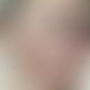 Chronische lymphatische Leukämie: diffuse flächige Infiltration des Gesichts. Facies leontina.
