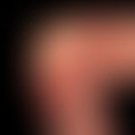 Hodgkin-Lymphom, Hautveränderungen: Bulllöses Pemphigoid bei Hodgkin-Lymphom

