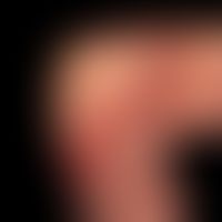 Hodgkin-Lymphom, Hautveränderungen: Bulllöses Pemphigoid bei Hodgkin-Lymphom
