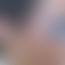 Hydroa vacciniforme-artige lymphoproliferative Erkrankung: flächiges Erythem, Lidschwellung, diss...