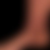 Insektenstichartige Reaktionen bei hämatologischer&nbsp;Neoplasie: kleinpapulöse juckende Läsione...