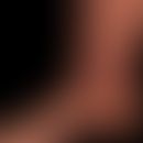 Insektensichartige Hautläsionen bei bekannter chronischer lymphatischer Leukämie.
