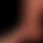 Insektensichartige Hautläsionen bei bekannter chronischer lymphatischer Leukämie.
