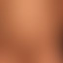 In den Blaschko-Linien verlaufender epidermaler Naevus.
