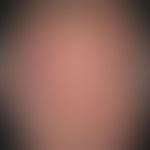 Alopecia androgenetica beim Mann. Stadium IV: Hufeisenförmige, komplette Lichtung der Haare im Pa...