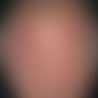 Alopecia androgenetica beim Mann. Stadium IV: Hufeisenförmige, komplette Lichtung der Haare im Pa...