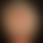Nicht vernarbende diffuse Alopezie: keine Grunderkrnakung eruierbar.
