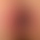 Chronische Analdermatitis (Analekzem) mit unscharf begrenzten, roten und schuppigen Plaques. Mari...