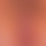 Differenzialdiagnose: Kumulativ-toxische&nbsp;anale Dermatitis

Diagnose: Lichen sclerosus mit be...