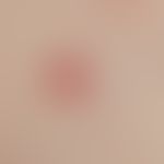 Angiom seniles: breitbasig aufsitzende, blutrote,&nbsp;oberflächenglatte&nbsp;Erhabenheit.&nbsp;
