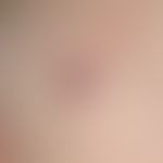 Angiom seniles: breitbasig aufsitzende, weiche, blutrote, oberflächenglatte&nbsp;Erhabenheit.

