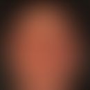 Akute&nbsp;kontaktallergische Dermatitis&nbsp;der Kopfhaut (Haarfärbemittel). Massive Schwellung ...