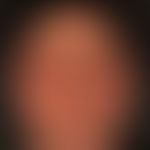 Akute&nbsp;kontaktallergische Dermatitis&nbsp;der Kopfhaut (Haarfärbemittel). Massive Schwellung ...