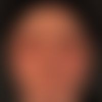 Akute&nbsp;kontaktallergische Dermatitis&nbsp;der Kopfhaut (Haarfärbemittel). Massive Schwellung ...