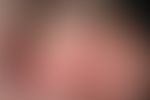 Röhrennagel bei chronischer Polyarthrtis&nbsp;
