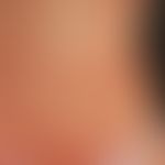 Arzneimittelexanthem lichenoides: kleinpapulöses, disseminiertes, stellenweise konfluiertes mäßig...
