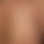 SDRIFE: juckendes symmetrisches Exanthem. Keine Allgemeinsymptomatik. Wahrscheinlich besteht ein ...