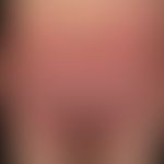 Symmetrical drug related intertriginous and flexural exanthema: randlich ist der papulöse Charakt...