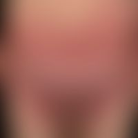 Symmetrical drug related intertriginous and flexural exanthema: randlich ist der papulöse Charakt...