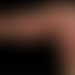 SDRIFE: juckendes symmetrisches Exanthem. Keine Allgemeinsymptomatik. Wahrscheinlich besteht ein ...