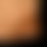 Erythema dyschromicum perstans:&nbsp;49 Jahre alter Mann. Seit mehreren Monaten bestehende, fläch...