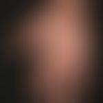 Atopische Dermatitis: rezidivierender Verlauf der atopischen Hautveränderungen. Derzeit weitgehen...