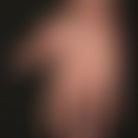 Atopische Dermatitis: rezidivierender Verlauf der atopischen Hautveränderungen. Derzeit weitgehen...