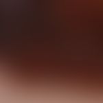 Melanom malignes Typ SSM s. Abbn. zuvor: Auflichtmikroskopischer Aspekt. Unregelmäßiges Pigmentmu...