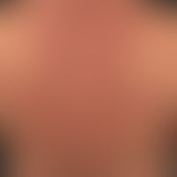 Scleroedema adultorum:&nbsp;seit &nbsp;mehreren Jahren bestehende, mit zunehmender Steifigkeit ei...